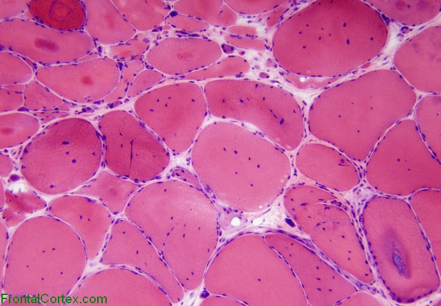 Myofibrillary myopathy, H&E stained slide x 100